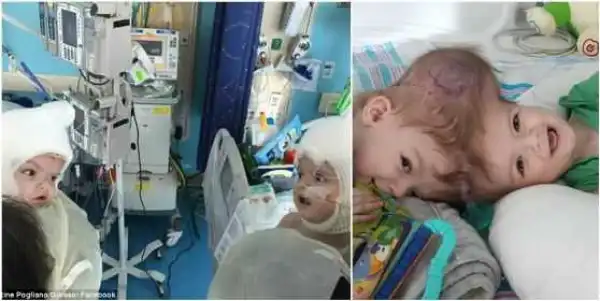 Twins conjoined at the head look at each other for the first time after a successful 27-hour surgery to separate them (Photos)